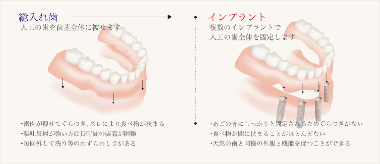 総入れ歯との比較