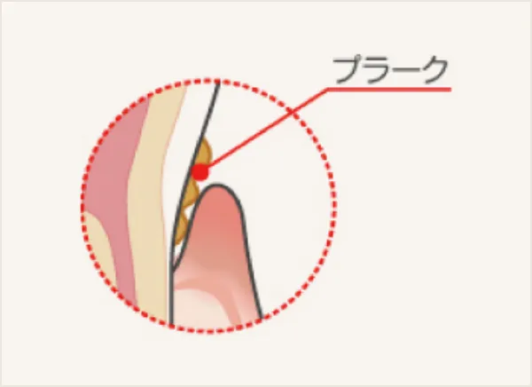歯周病の原因