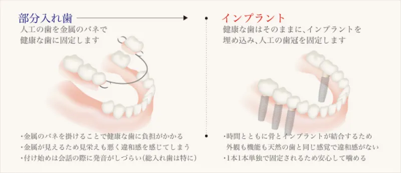 部分入れ歯との比較
